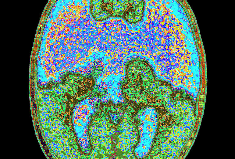 1 coloured mri brain scan showing holoprosencephaly mehau kulykscience photo library 001