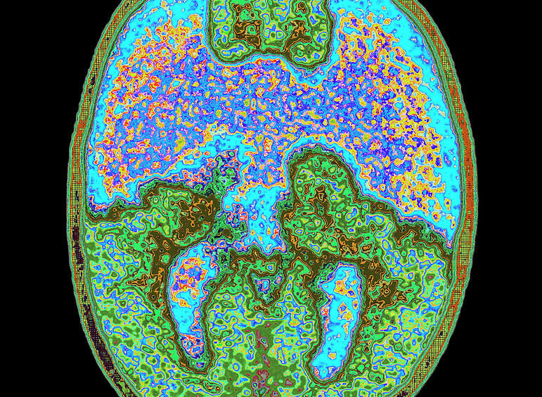 1 coloured mri brain scan showing holoprosencephaly mehau kulykscience photo library 001