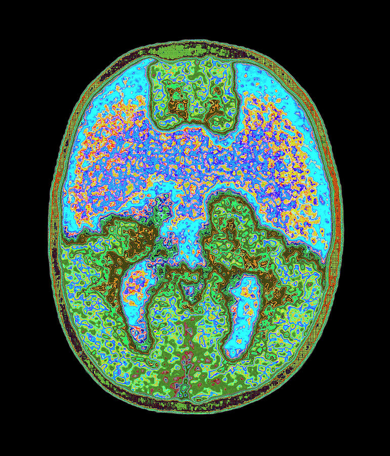 1 coloured mri brain scan showing holoprosencephaly mehau kulykscience photo library 001