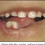 Fibrodysplasia Ossificans Progressiva (FOP) Hastalığı Belirtileri? Sebepleri? Tedavi Yöntemleri Nelerdir?