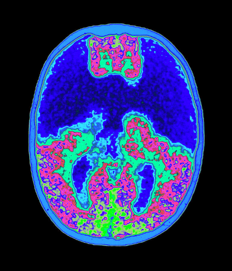 2 coloured mri brain scan showing holoprosencephaly mehau kulykscience photo library