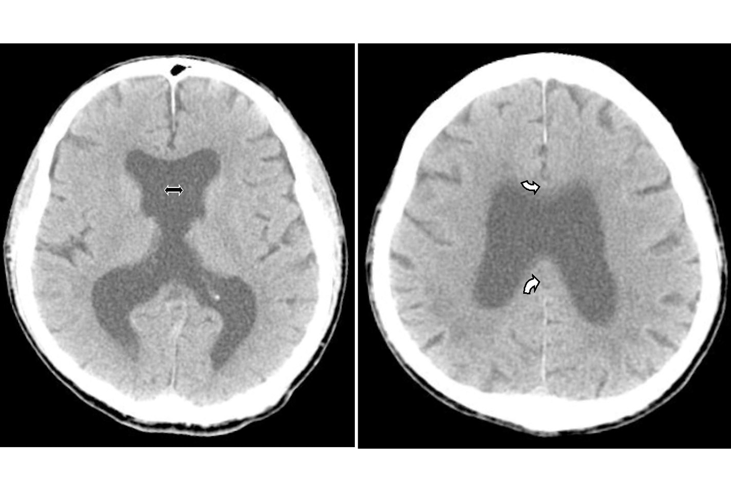 23 holoprosencephaly in an aged man images