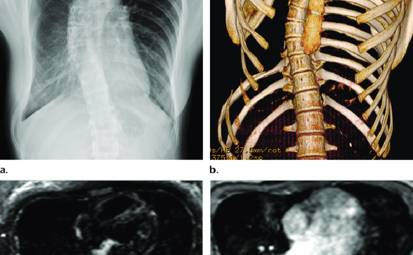 Gorham Stout syndrome in a 13 year old girl who presented with back pain a b