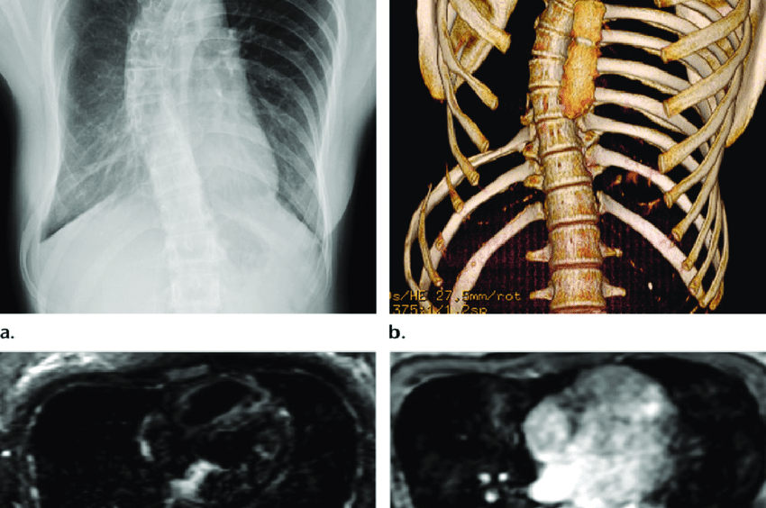 Gorham Stout syndrome in a 13 year old girl who presented with back pain a b