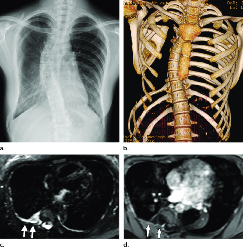 Gorham Stout syndrome in a 13 year old girl who presented with back pain a b