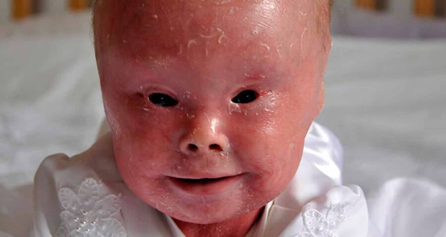 baby with harlequin ichthyosis