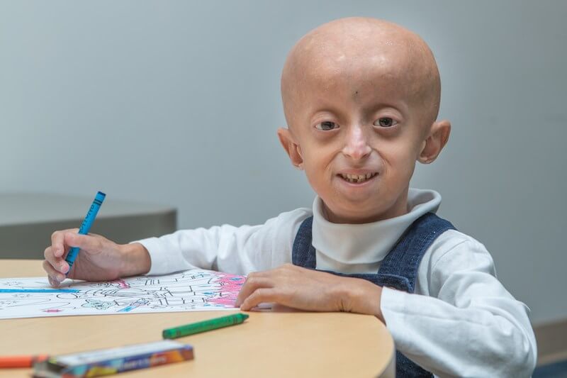 child with progeria carlos courtesy progeria research foundation