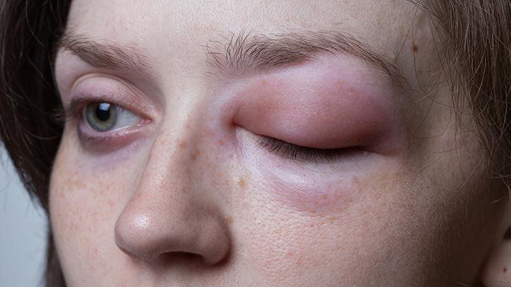 hereditary angioedema signs and symptoms 722x406