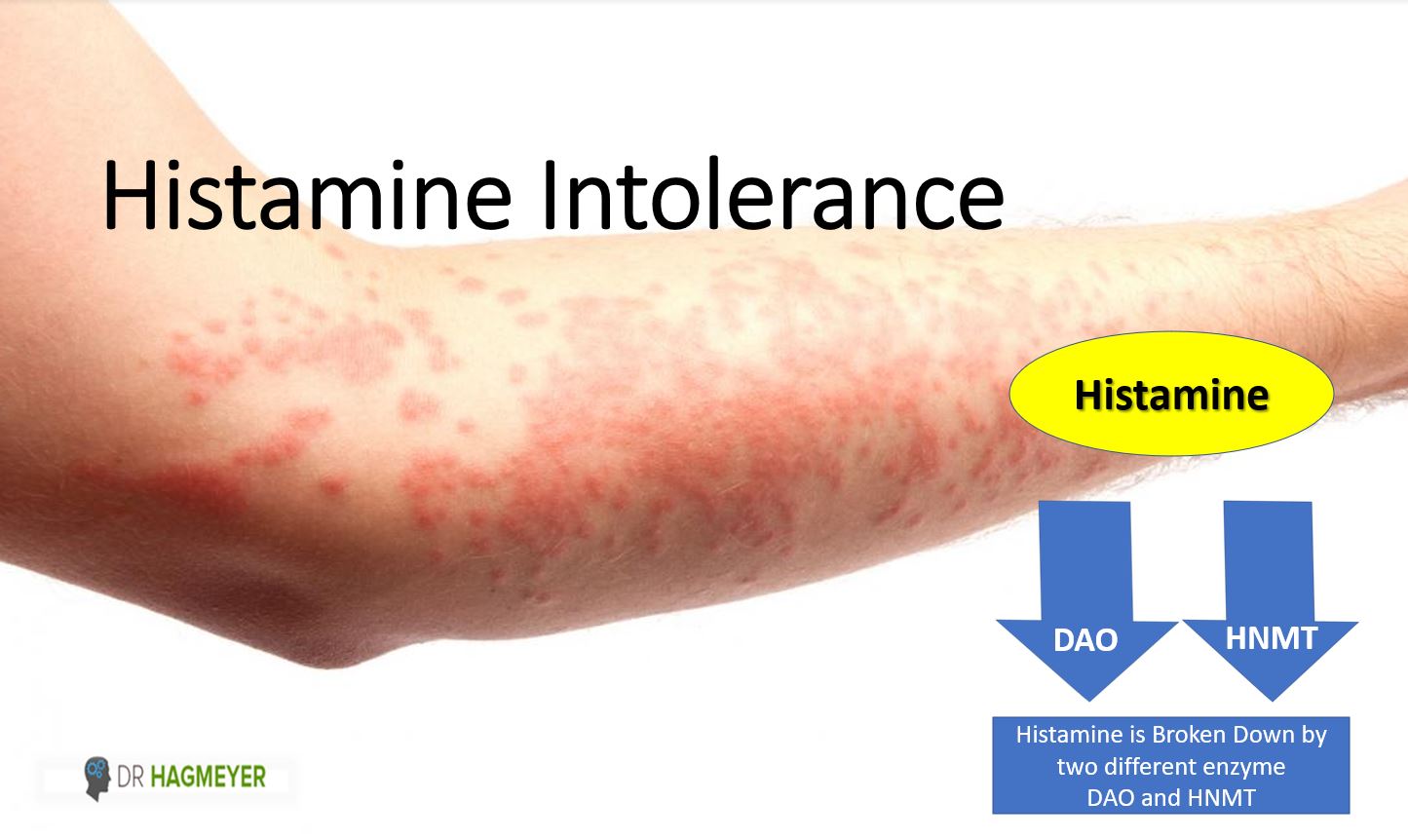 Gluten İntoleransı mı Histamin Duyarlılığı mı Belirtileri Ayırt Etme Rehberi3